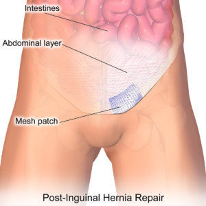 inguinal_hernia_patch-300x300